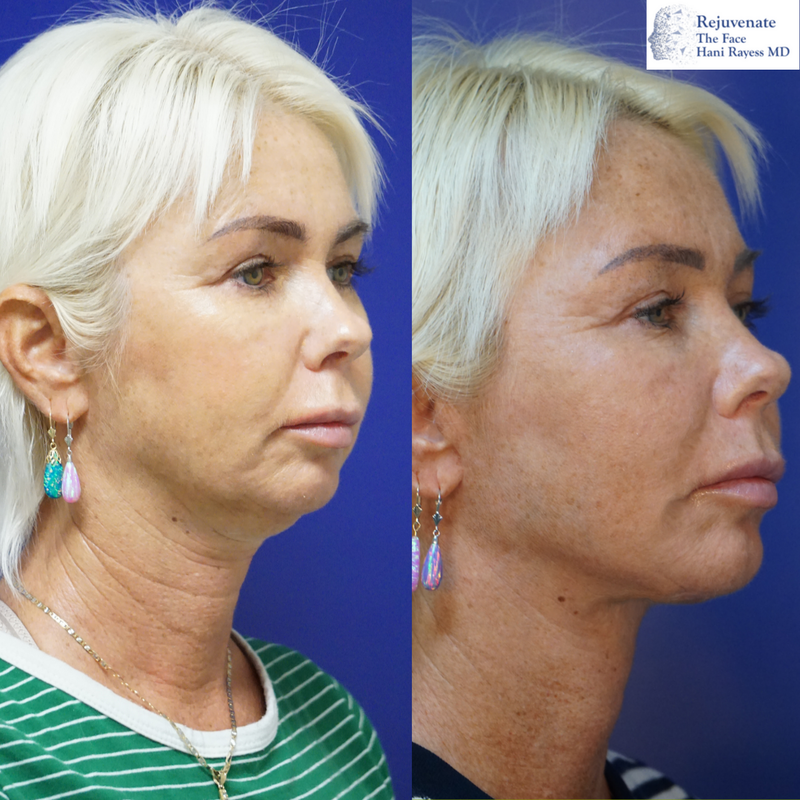 St Pete deep plane facelift and necklift before and after
