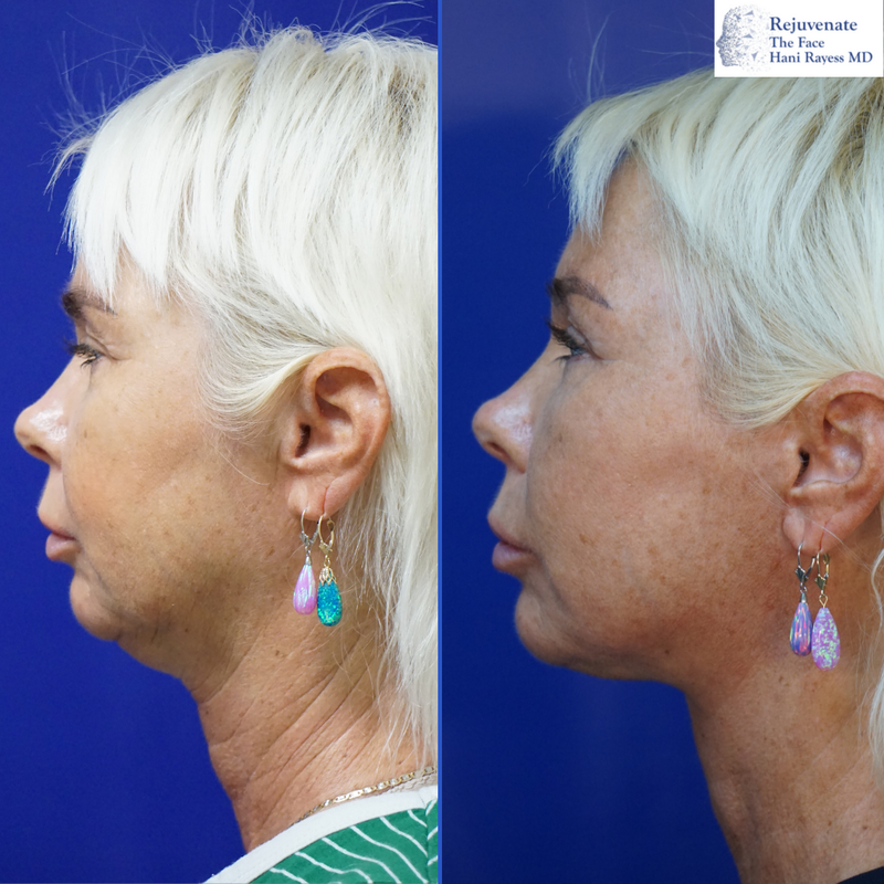 Tampa deep plane facelift and necklift before and after