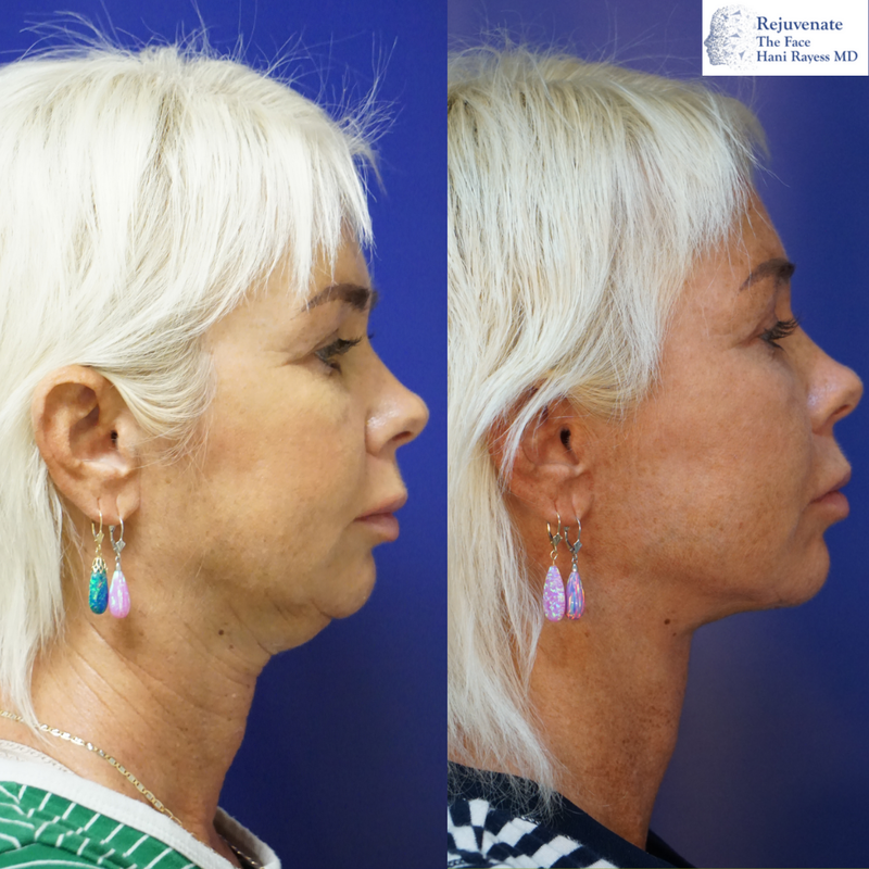 Florida deep plane facelift and necklift before and after