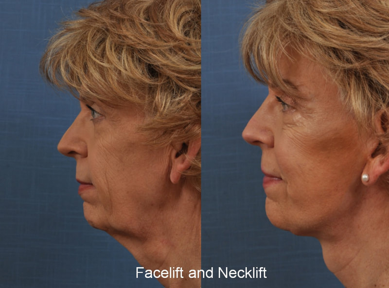 facelift and neck lift