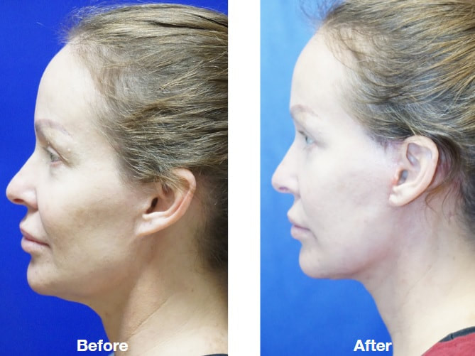 Best deep plane facelift in florida before and after