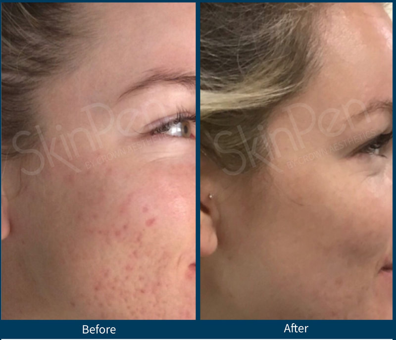 Microneedling in Tampa