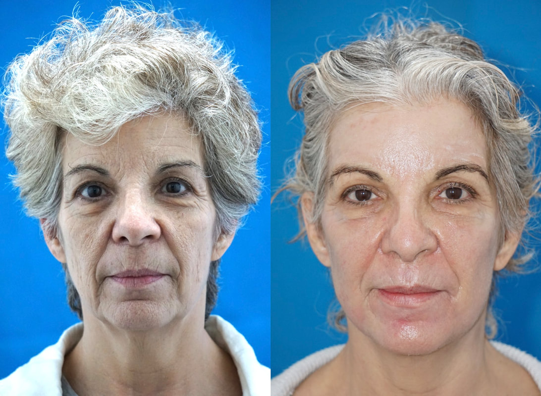 Chemical Peel in Tampa and Palm Harbor Before and After