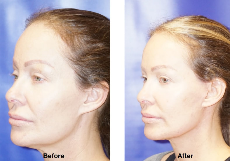 Tampa deep plane facelift before and after