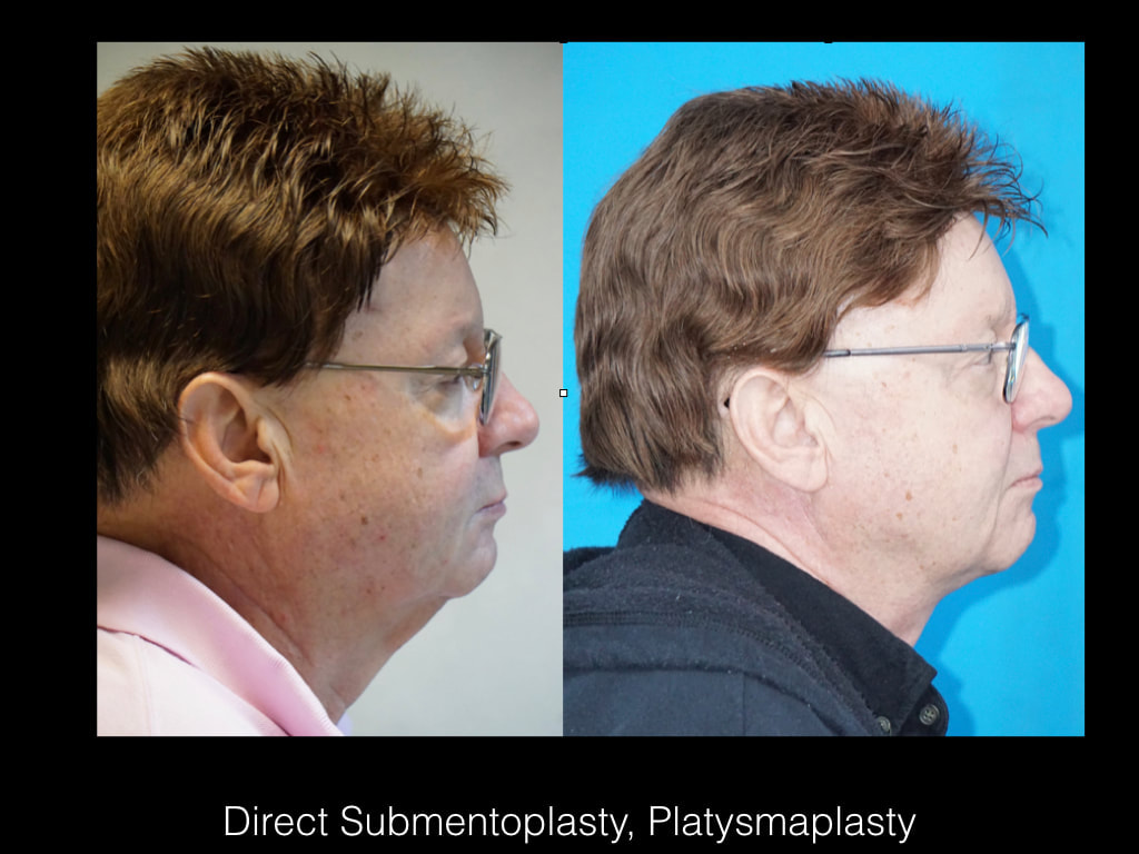 direct neck lift before and after