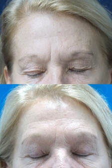 brow lift in tampa before and after