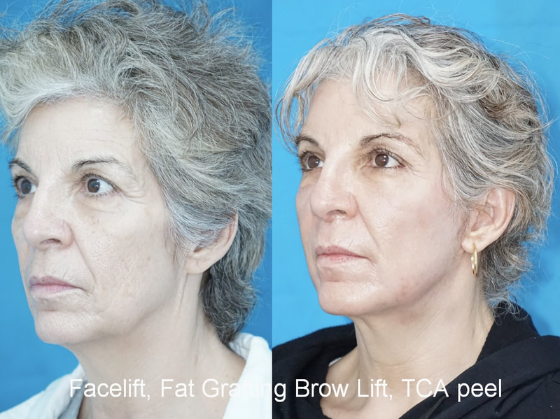 Tampa facelift, fat grafting and browlift
