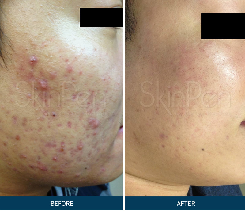 MIcroneedling in tampa before and after
