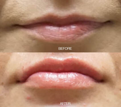 Lip Filler in Tampa Before and After