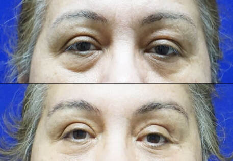 Lower Eyelid Surgery In Tampa Before and After