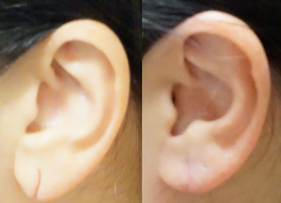Tampa and Palm Harbor Ear lobe Repair before and After