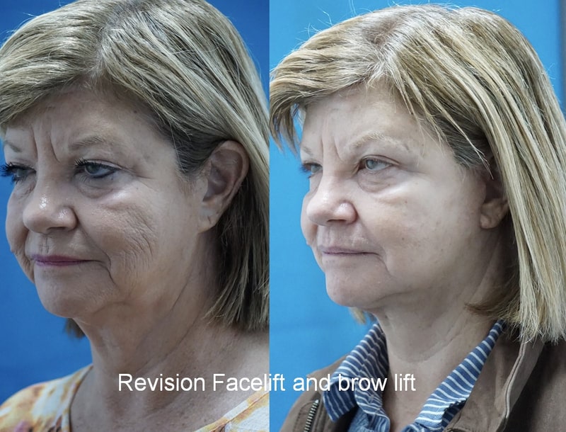 Tampa facelift and brow lift before and after