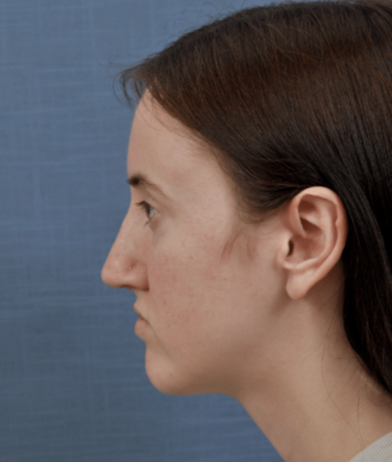 Rhinoplasty in Tampa After