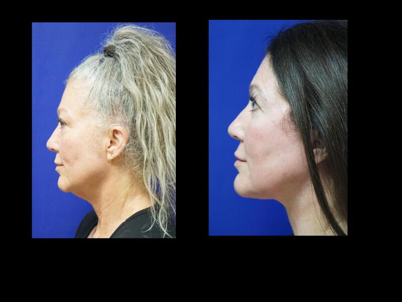 Tampa Facelift, necklift, eyelid surgery Co2 Laser resurfacing before and after