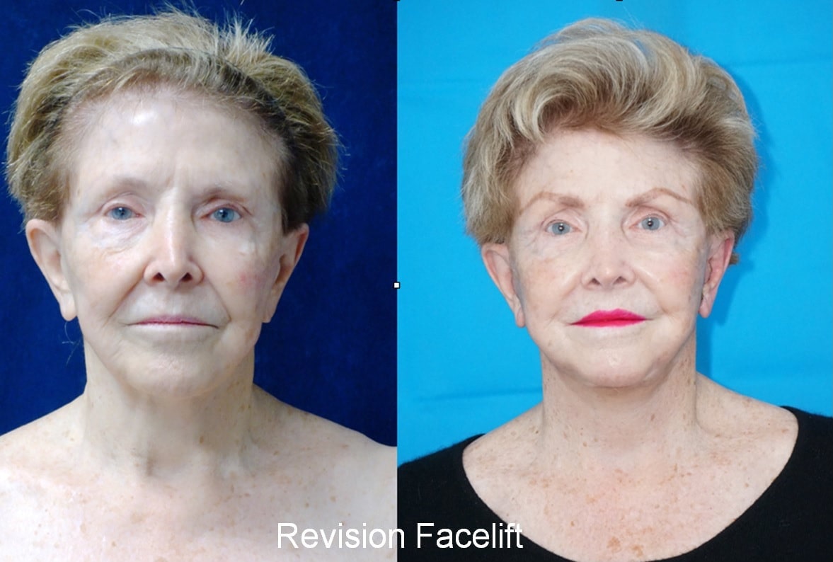 Tampa facelift before and after