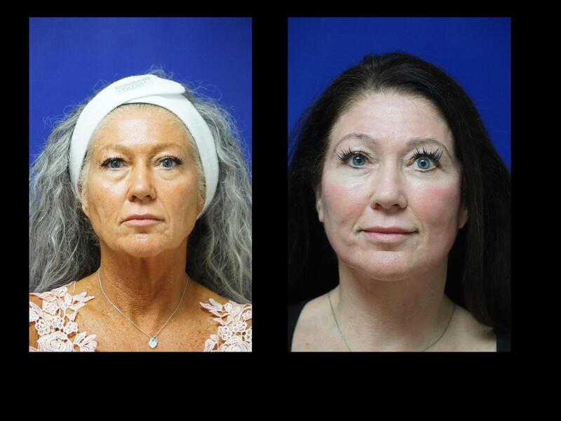 Tampa Facelift, necklift, eyelid surgery Co2 Laser resurfacing before and after