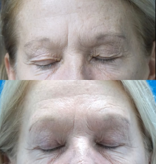 Tampa Upper eyelid surgery and brow lift