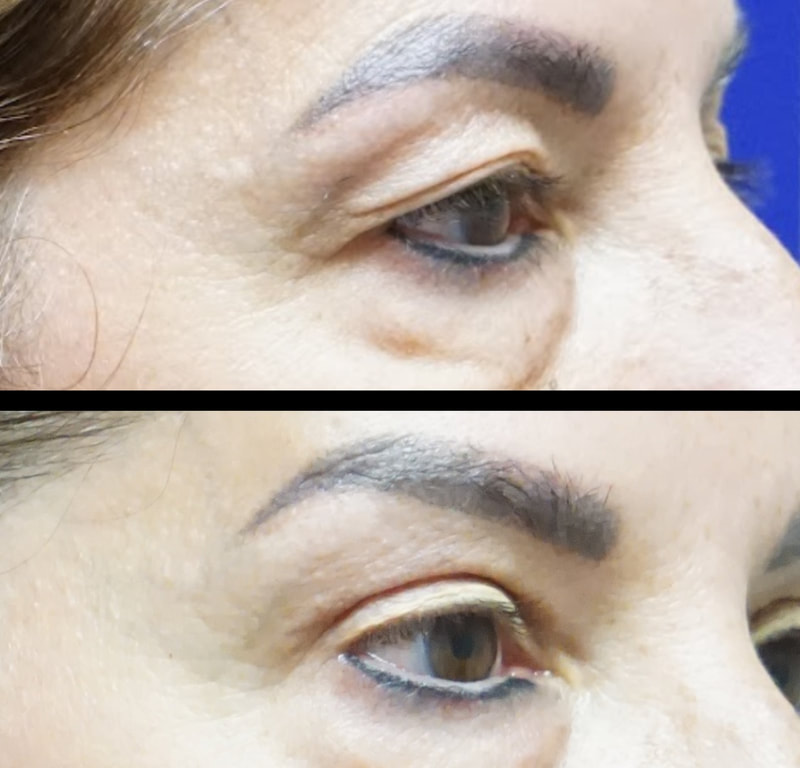 Upper eyelid surgery and brow lift in Tampa before and after