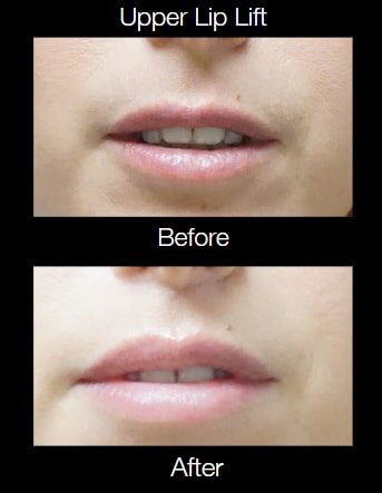 Upper Lip lift in Tampa before and after
