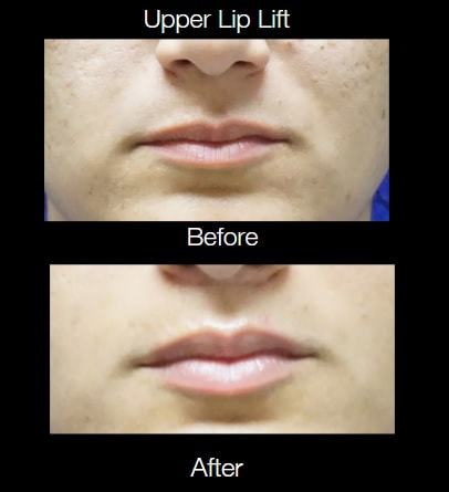 Lip Lift in Tampa Before and After